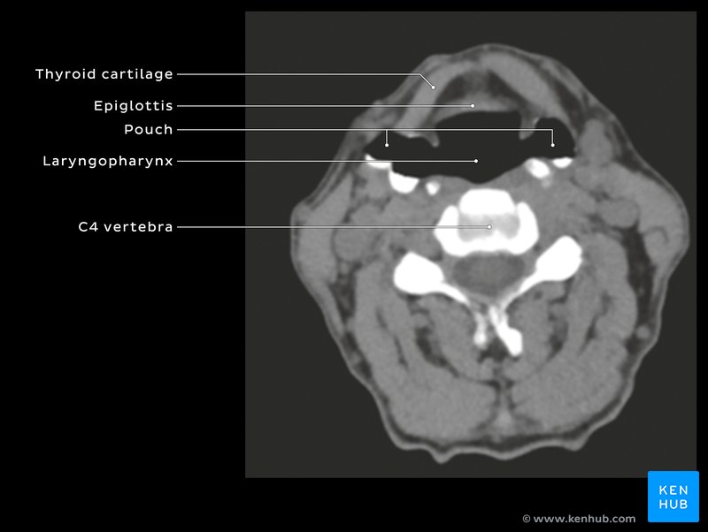 Pharyngeal diverticuli - axial CT of neck