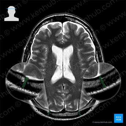 Lambdoid suture (Sutura lambdoidea); Image: 