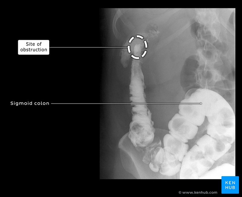 Bowel obstruction at the splenic flexure