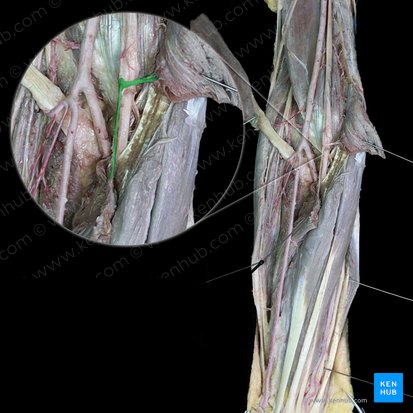 Muscular branches of median nerve to pronator teres muscle (Rami musculares nervi mediani cum musculus pronator teres); Image: 