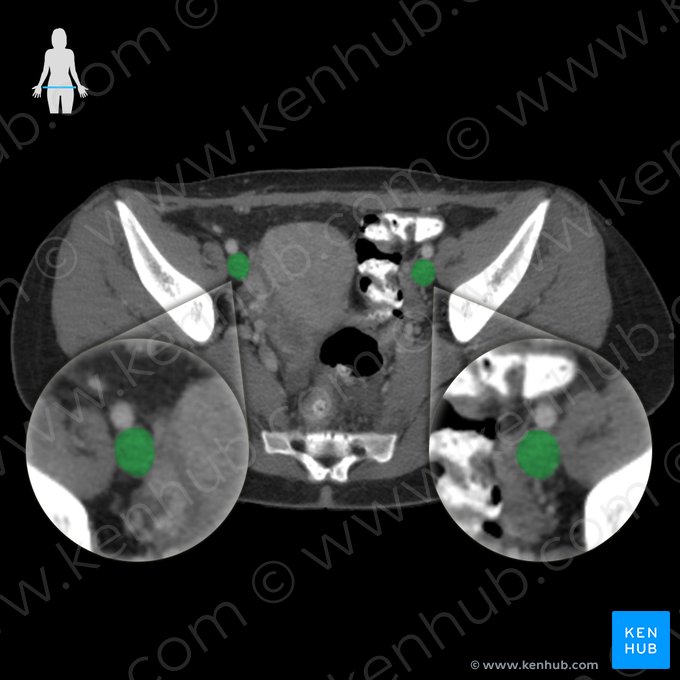 External iliac vein (Vena iliaca externa); Image: 