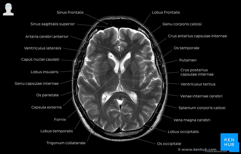 T2-gewichtetes MRT des Gehirns auf Höhe des Thalamus