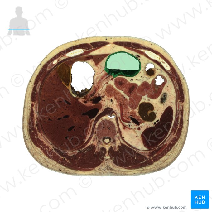 Antrum pyloricum (Pförtnerhöhle des Magens); Bild: National Library of Medicine