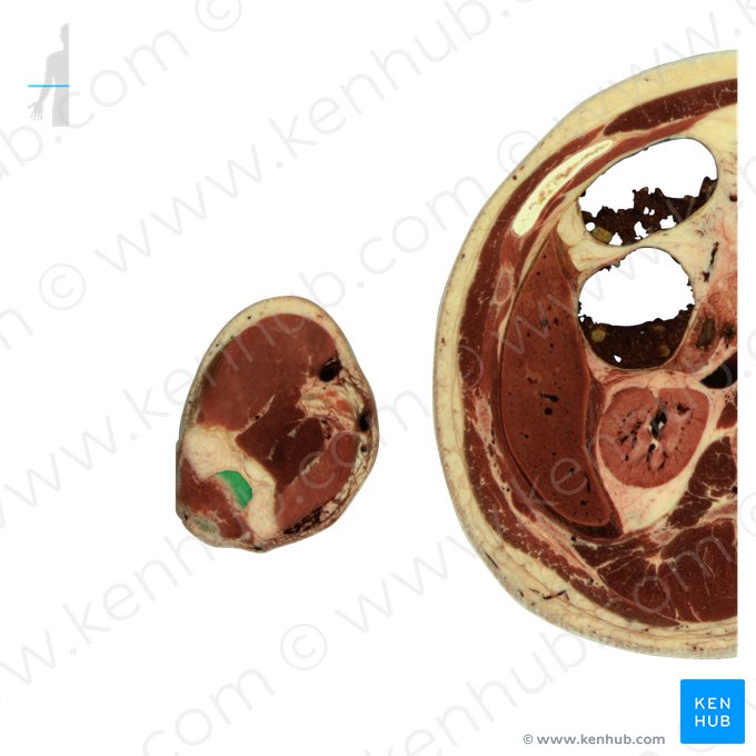 Olecranon fossa of humerus (Fossa olecrani humeri); Image: National Library of Medicine