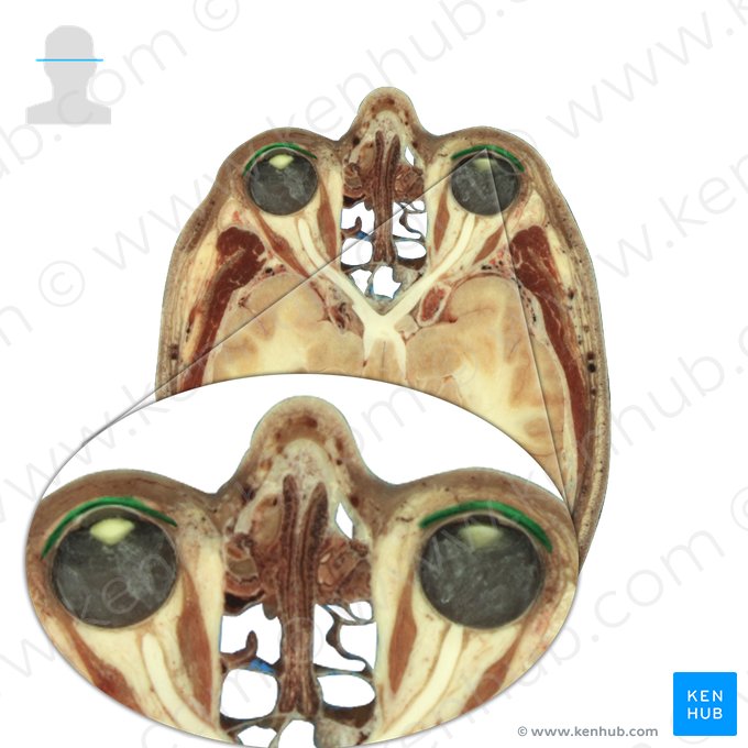 Músculos orbiculares dos olhos (Musculus orbicularis oculi); Imagem: National Library of Medicine