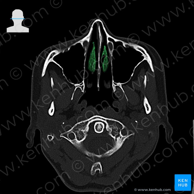 Cornete nasal medio del hueso etmoides (Concha media nasi ossis ethmoidalis); Imagen: 