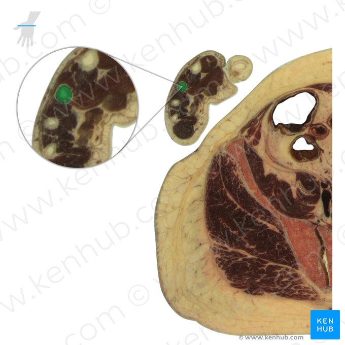 3rd metacarpal bone (Os metacarpi 3); Image: National Library of Medicine