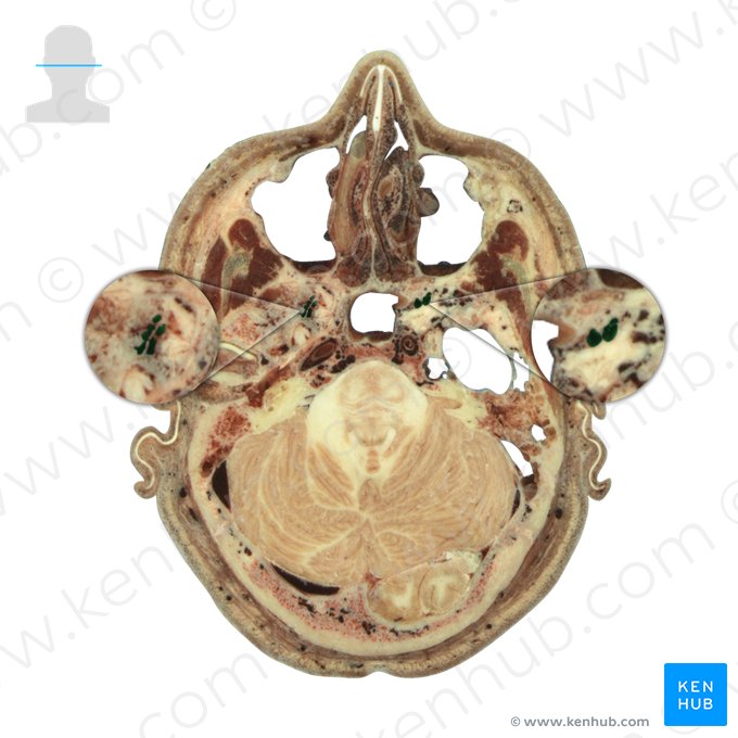 Plexo venoso pterigóideo (Plexus venosus pterygoideus); Imagem: National Library of Medicine