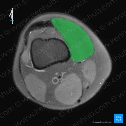 Vastus medialis muscle (Musculus vastus medialis); Image: 