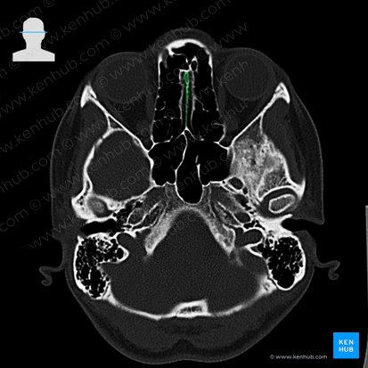 Nasal septum (Septum nasi); Image: 