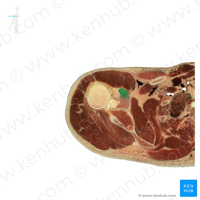 Processo coracoide da escápula (Processus coracoideus scapulae); Imagem: National Library of Medicine