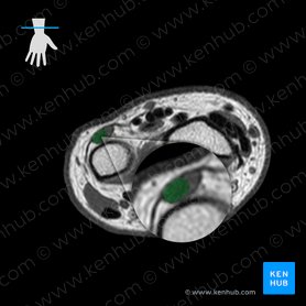 Tendon of extensor carpi ulnaris muscle (Tendo musculi extensoris carpi ulnaris); Image: 