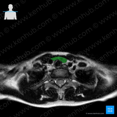 Isthmus glandulae thyroideae (Isthmus der Schilddrüse); Bild: 