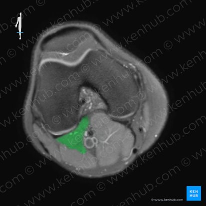 Musculus plantaris (Fußsohlenmuskel); Bild: 