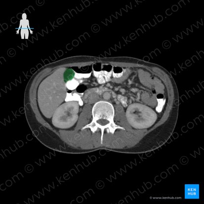 Gallbladder (Vesica biliaris); Image: 