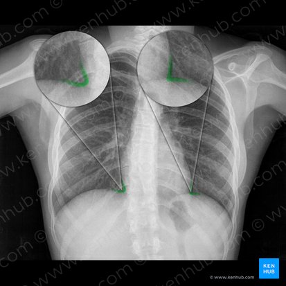 Cardiophrenic angle (Angulus cardiophrenicus); Image: 