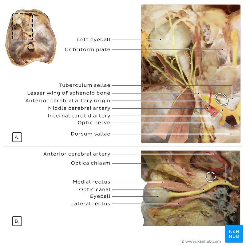 Left orbit and sella turcica - cadaveric image