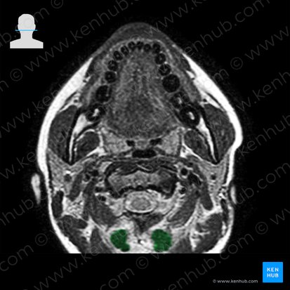 Musculus rectus capitis posterior major (Großer hinterer gerader Kopfmuskel); Bild: 