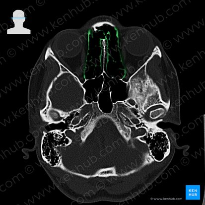 Ethmoid bone (Os ethmoidale); Image: 