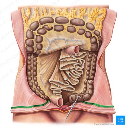 Prega umbilical lateral (Plica umbilicalis lateralis); Imagem: Liene Znotina