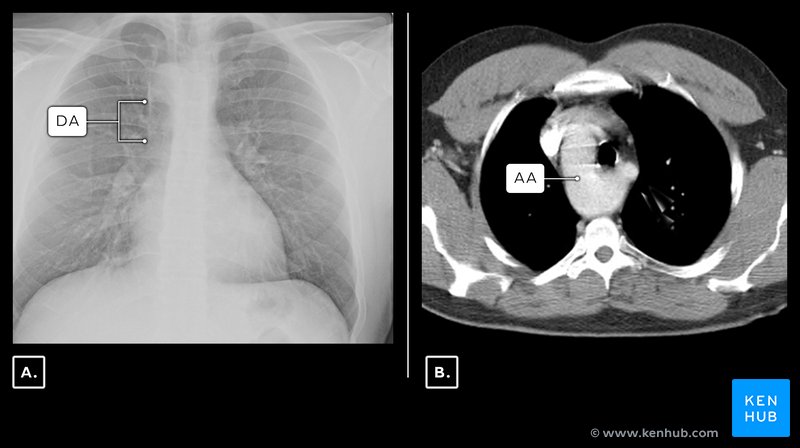 Right sided aortic arch - Axial CT