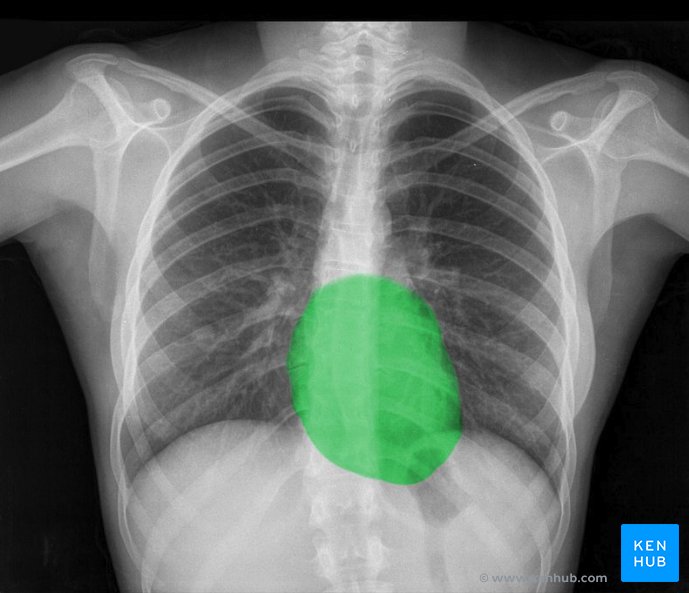 Radiografía de tórax normal: Tutorial de anatomía | Kenhub