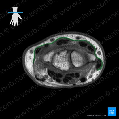 Retináculo dos extensores da mão (Retinaculum extensorum carpi); Imagem: 