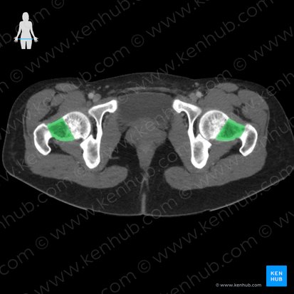 Neck of femur (Collum ossis femoris); Image: 