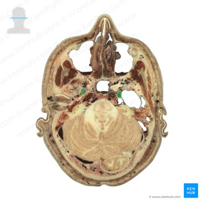Nervo mandibular (Nervus mandibularis); Imagem: National Library of Medicine