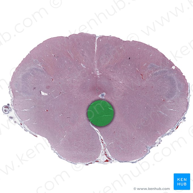 Decusación del lemnisco medial (Decussatio lemniscorum medialium); Imagen: 