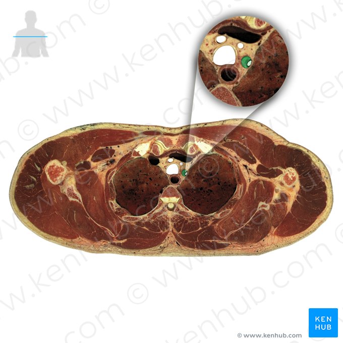 Arteria subclavia sinistra (Linke Unterschlüsselbeinarterie); Bild: National Library of Medicine