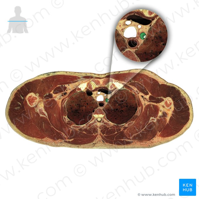 Artéria subclávia esquerda (Arteria subclavia sinistra); Imagem: National Library of Medicine