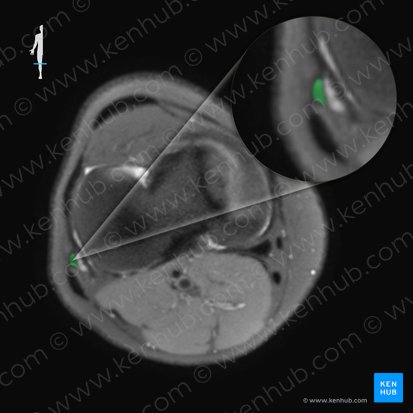 Ligamentum collaterale fibulare genus (Äußeres Kollateralband des Knies); Bild: 