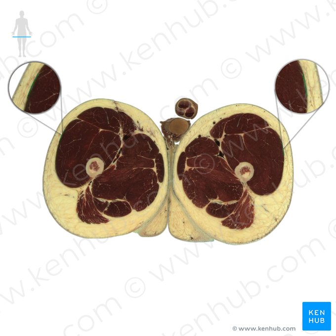 Trato iliotibial (Tractus iliotibialis); Imagem: National Library of Medicine