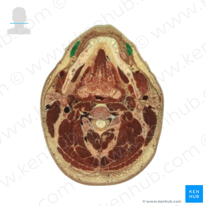 Musculus depressor anguli oris (Mundwinkelsenker); Bild: National Library of Medicine