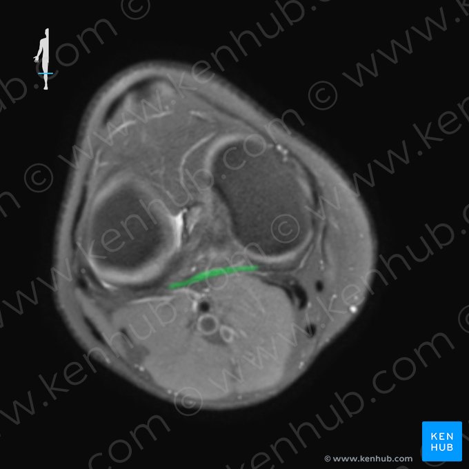 Ligamentum popliteum obliquum (Schräges Kniekehlenband); Bild: 