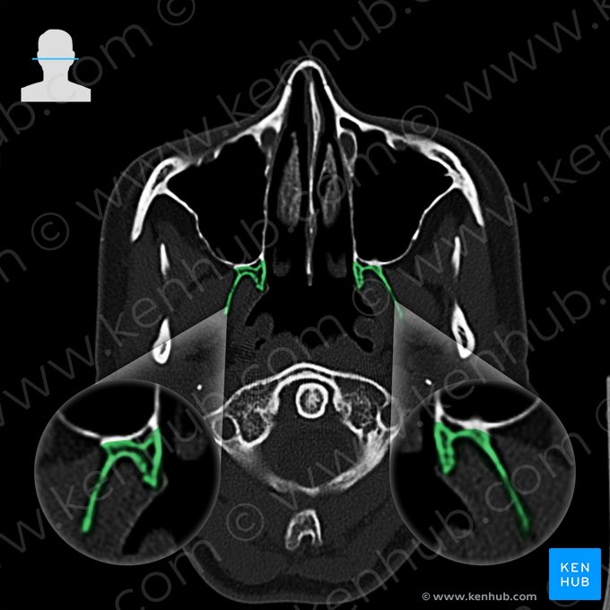 Pterygoid process of sphenoid bone (Processus pterygoideus ossis sphenoidalis); Image: 