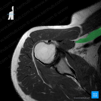 Pectoralis minor muscle (Musculus pectoralis minor); Image: 