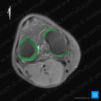 Cartilago articularis genus (Gelenkknorpel des Knies); Bild: 