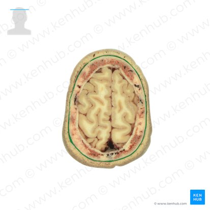 Frontalis muscle & epicranial aponeurosis (Musculus frontalis & galea aponeurotica); Image: National Library of Medicine