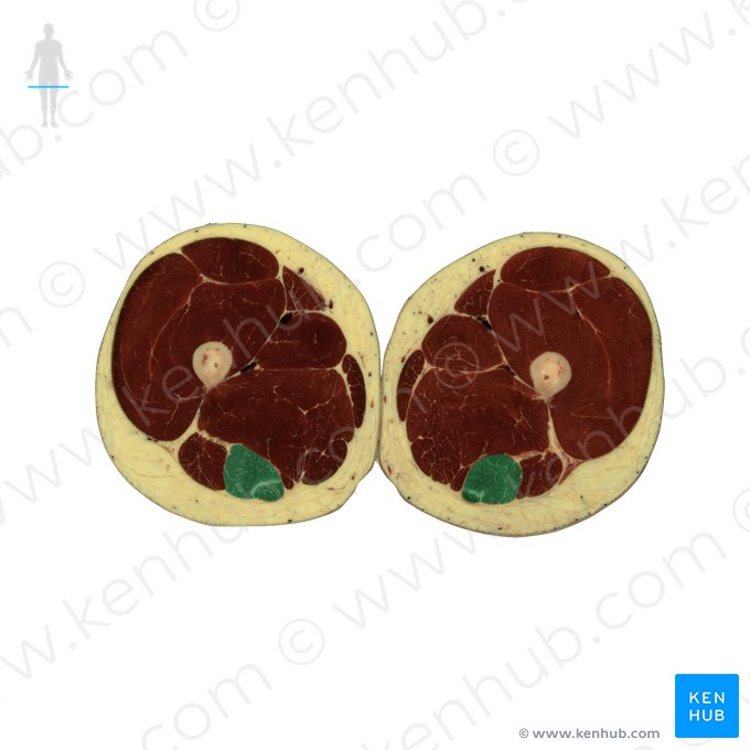 Músculo semitendíneo (Musculus semitendinosus); Imagem: National Library of Medicine