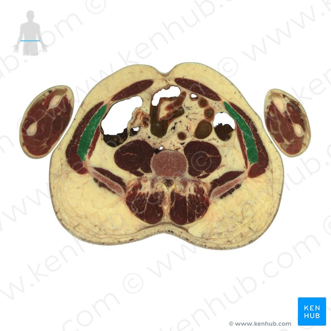 Internal abdominal oblique muscle (Musculus obliquus internus abdominis); Image: National Library of Medicine