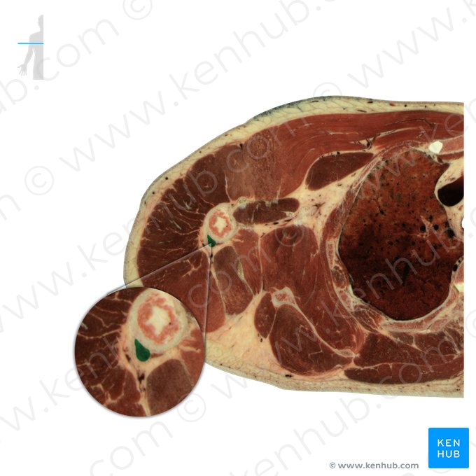 Caput laterale musculi tricipitis brachii (Seitlicher Kopf des dreiköpfigen Oberarmmuskels); Bild: National Library of Medicine