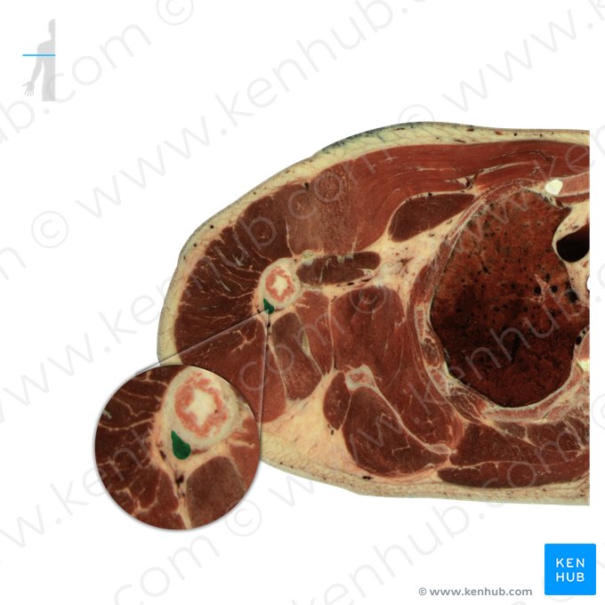 Cabeça lateral do músculo tríceps braquial (Caput laterale musculi tricipitis brachii); Imagem: National Library of Medicine