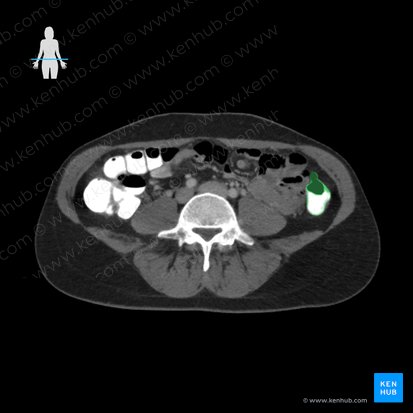Descending colon (Colon descendens); Image: 