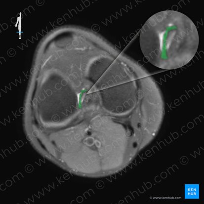 Ligamentum cruciatum anterius (Vorderes Kreuzband); Bild: 