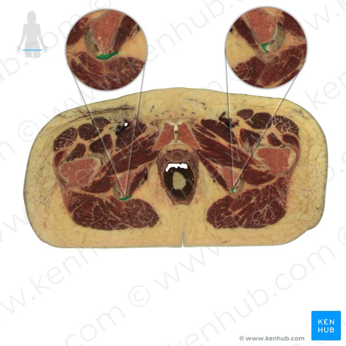 Ligamentum sacrotuberale (Kreuzbein-Sitzbeinhöcker-Band); Bild: National Library of Medicine