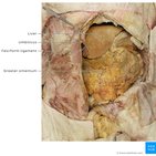 Clinical case: Sister Mary Joseph nodule