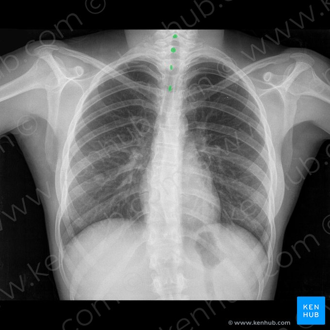 Processo espinhoso da vértebra (Processus spinosus vertebrae); Imagem: 