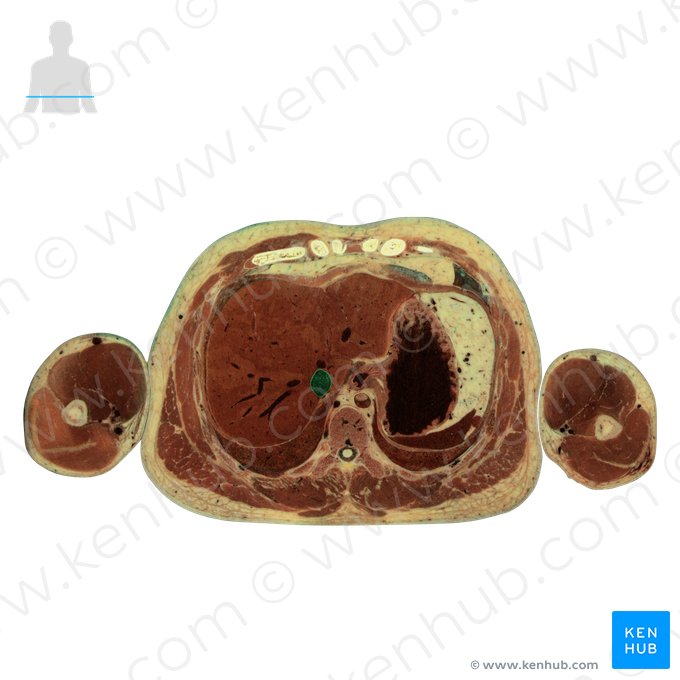 Veia cava inferior (Vena cava inferior); Imagem: National Library of Medicine